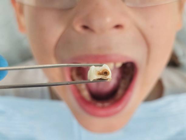 Best Emergency Wisdom Tooth Extraction in Galveston, IN